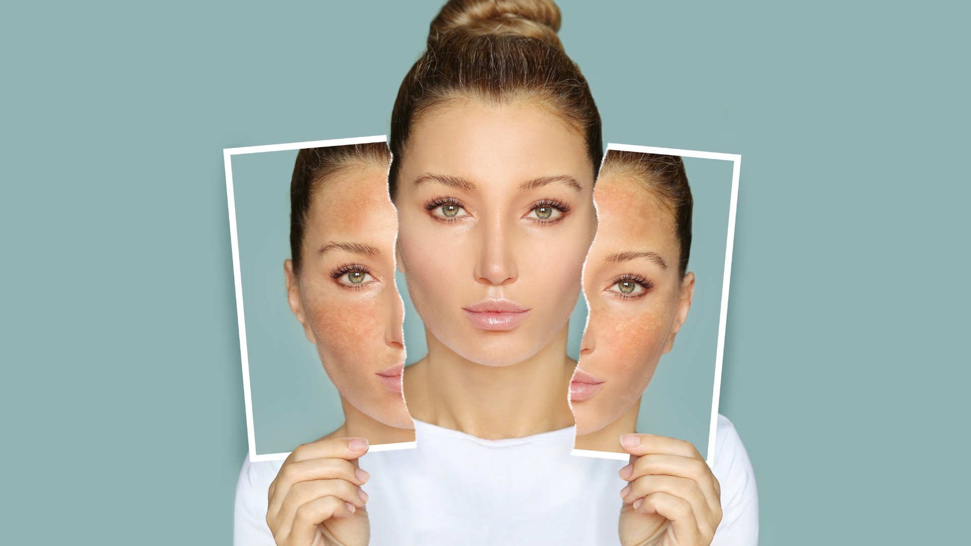 Melasma: A Nutrição Pode Ajudar